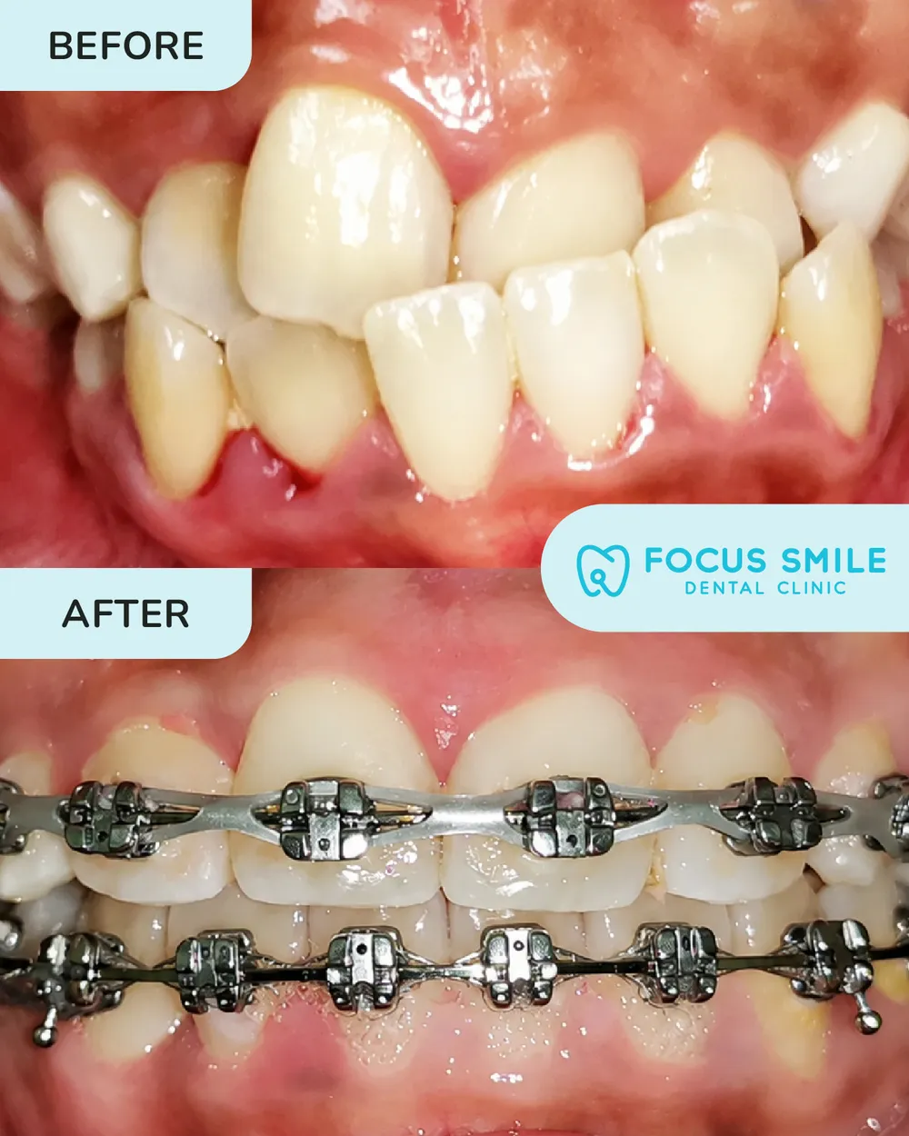 Braces before and after result at Focus Smile Dental
