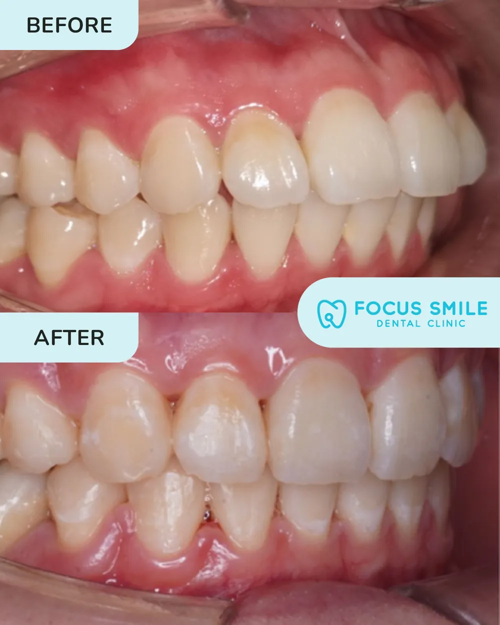 Braces before and after, case 6, at Focus Smile Dental