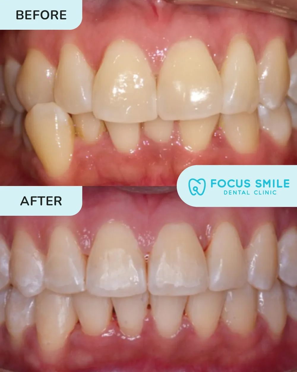 Braces before and after, case 8, at Focus Smile Dental