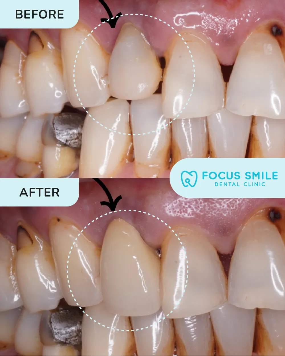 Mahkota dan jambatan gigi sebelum dan selepas, kes 1, di Focus Smile Dental
