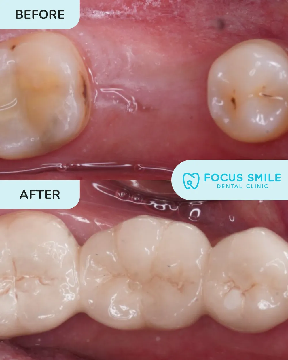 Mahkota & Jambatan Gigi before and after result at Focus Smile Dental