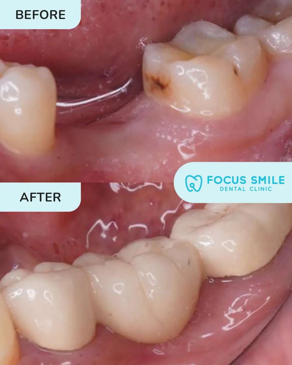Mahkota dan jambatan gigi sebelum dan selepas, kes 3, di Focus Smile Dental