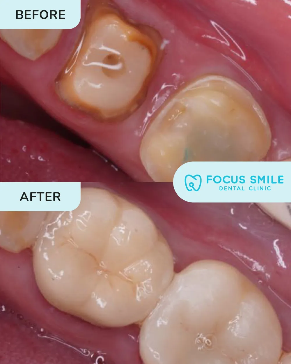 Mahkota & Jambatan Gigi before and after result at Focus Smile Dental