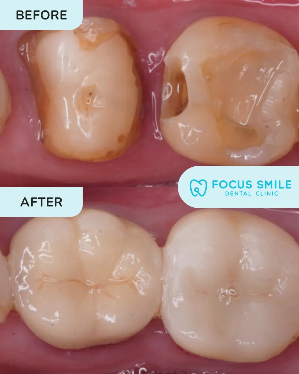 Mahkota dan jambatan gigi sebelum dan selepas, kes 5, di Focus Smile Dental