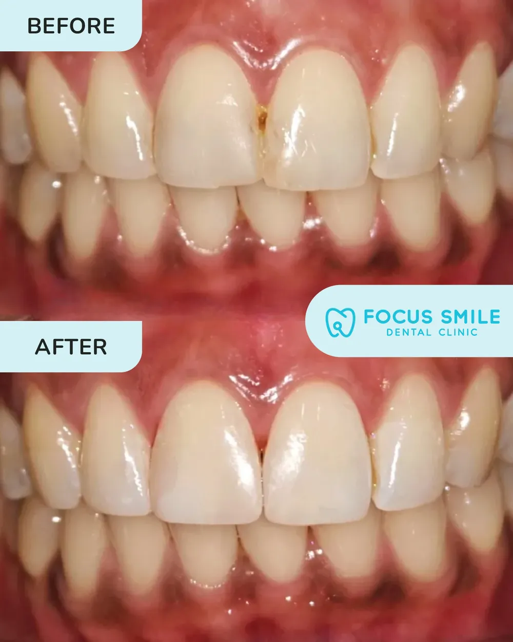 Dental filling before and after, case 1, at Focus Smile Dental