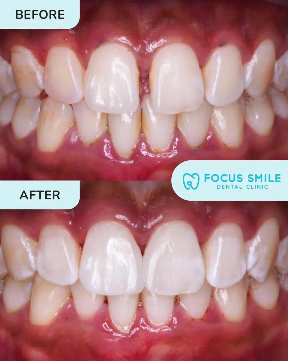 Dental filling before and after, case 2, at Focus Smile Dental