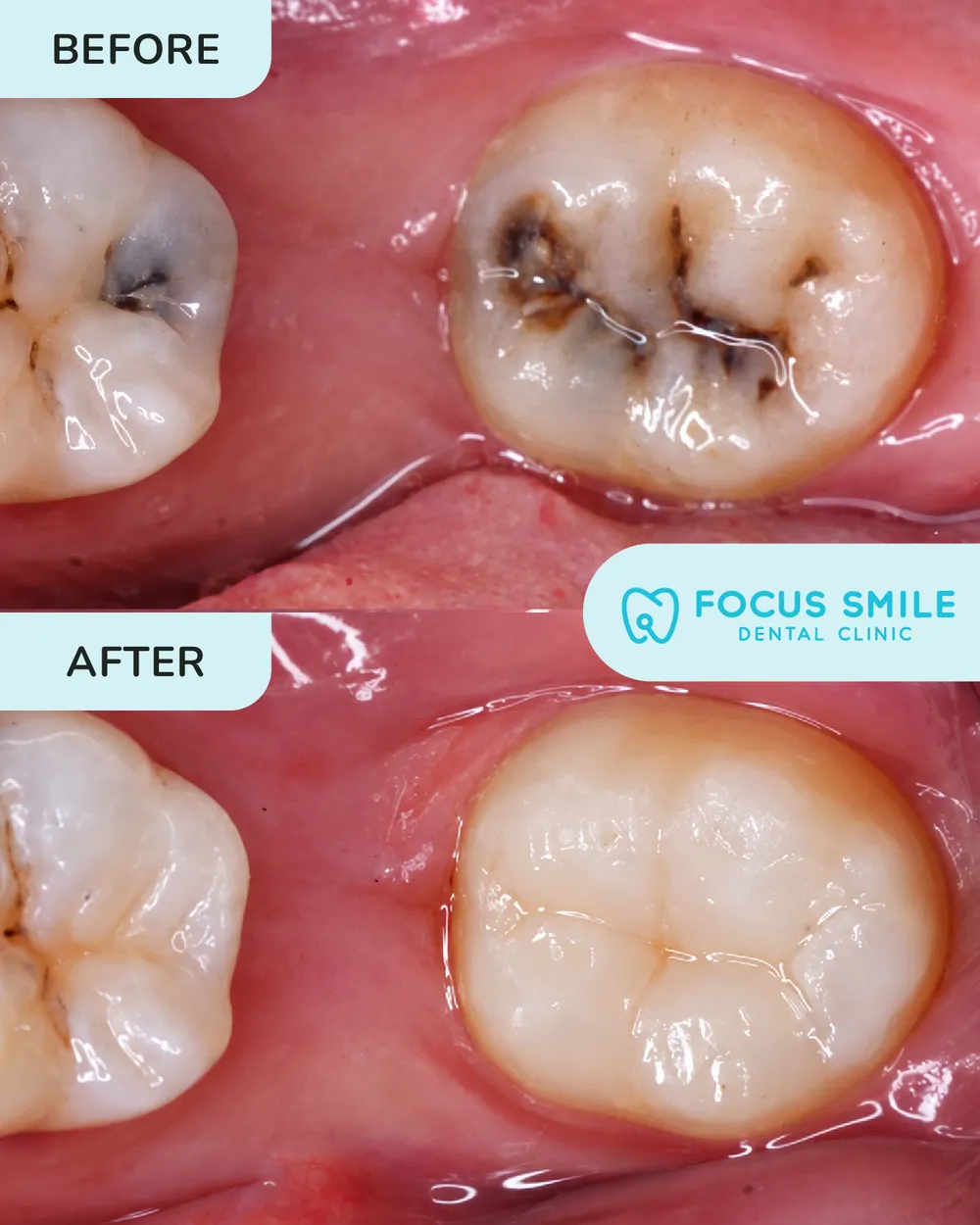 Tampalan Gigi before and after result at Focus Smile Dental