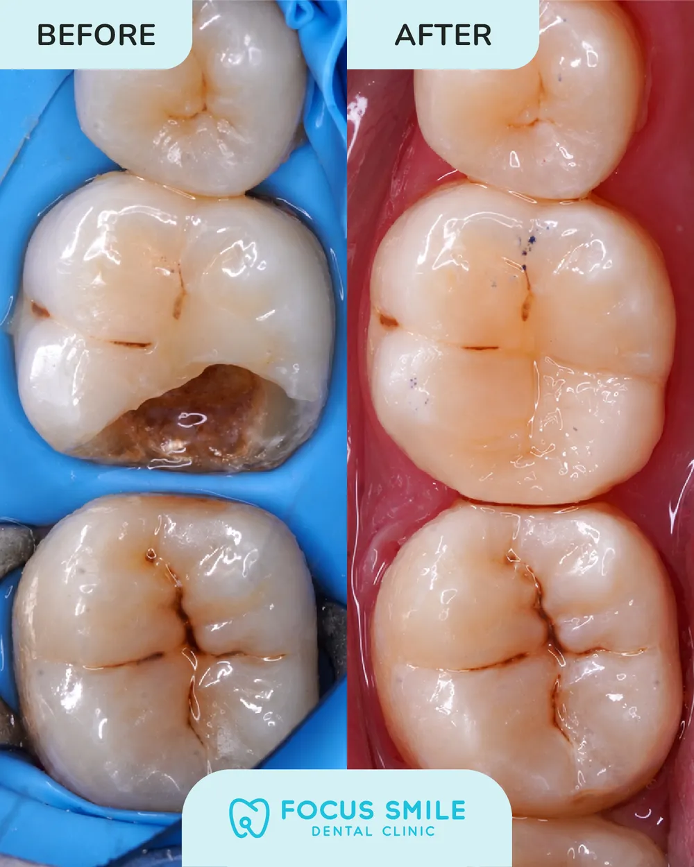Tampalan Gigi before and after result at Focus Smile Dental