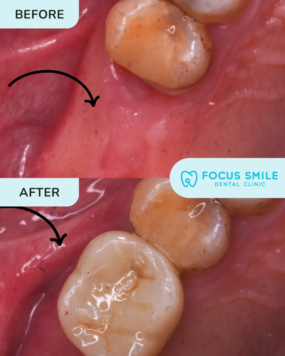 Dental implant before and after, case 1, at Focus Smile Dental
