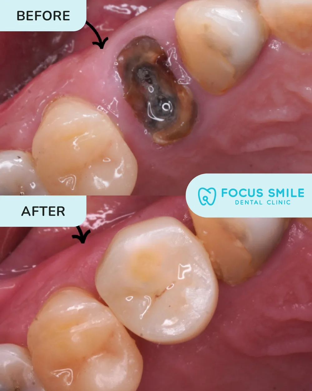 Dental implant before and after, case 2, at Focus Smile Dental