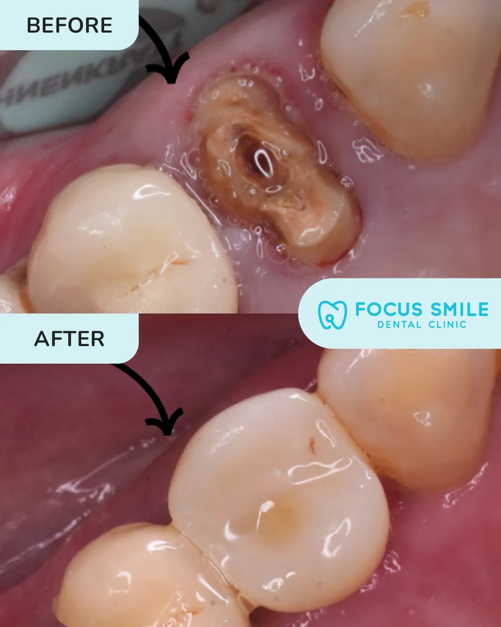 Implan Gigi before and after result at Focus Smile Dental