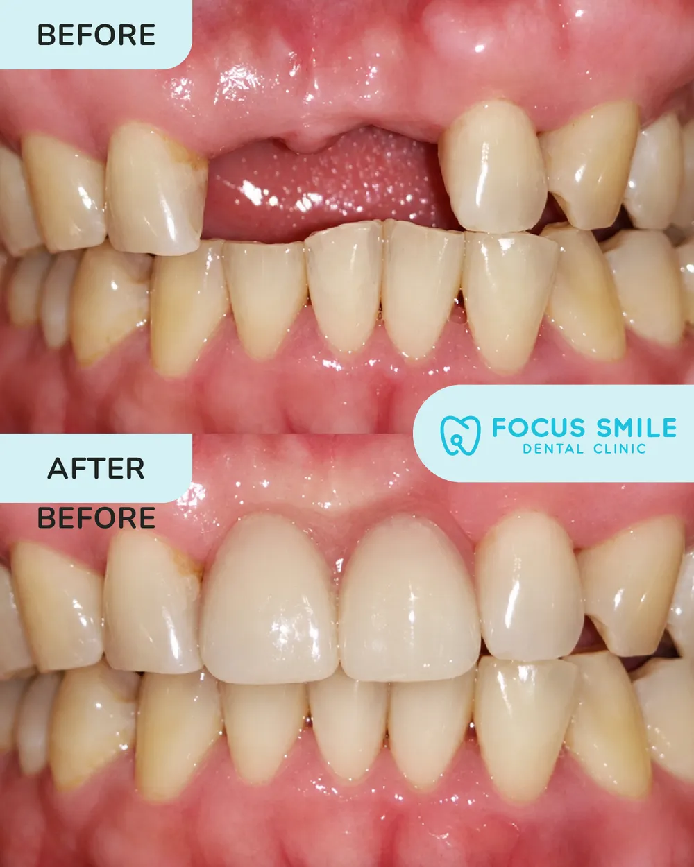 Gigi palsu sebelum dan selepas, kes 1, di Focus Smile Dental