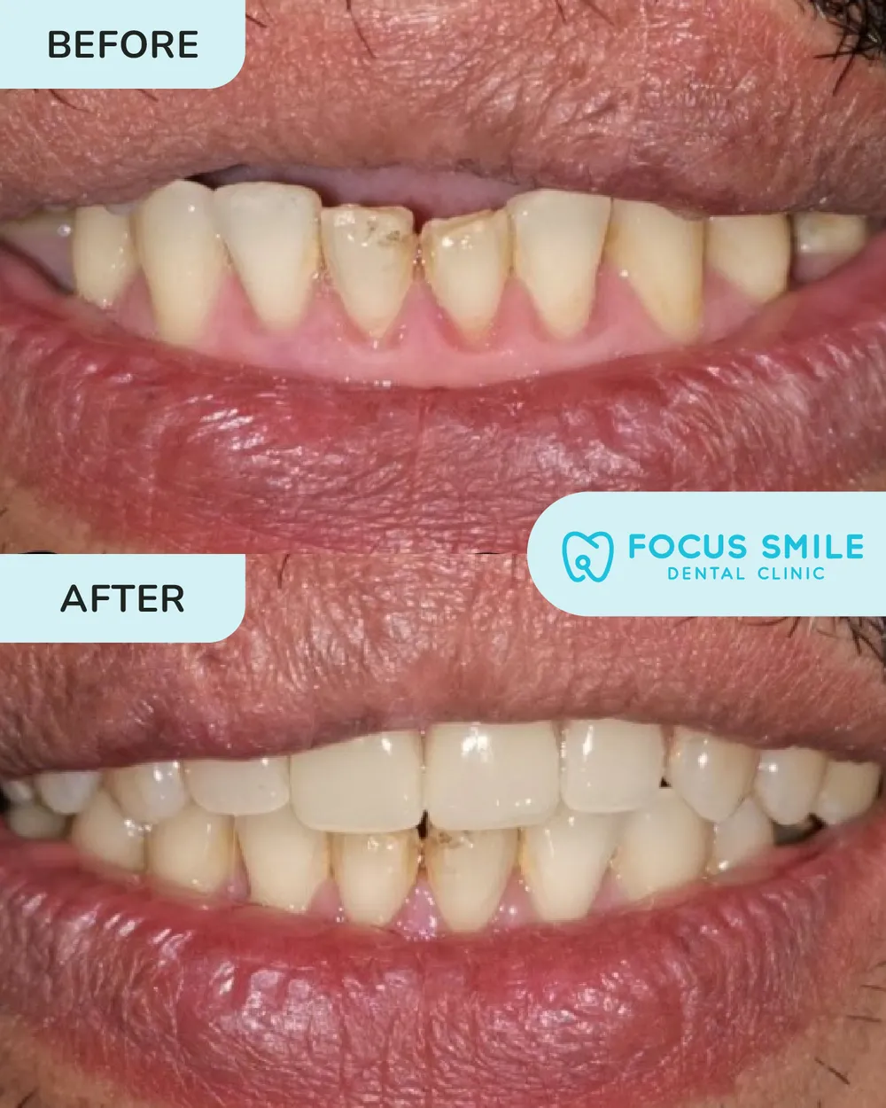 Gigi Palsu before and after result at Focus Smile Dental