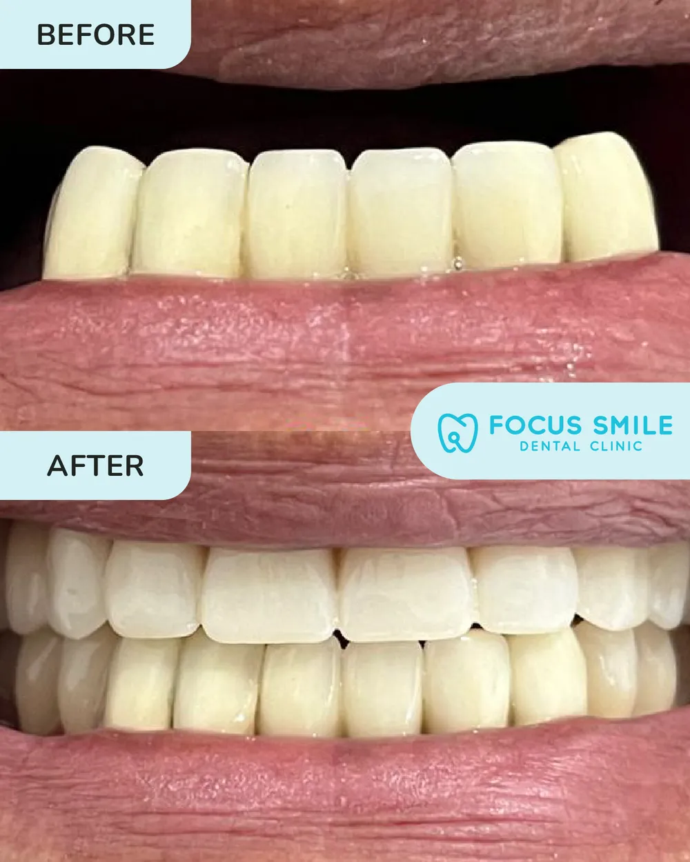 Gigi palsu sebelum dan selepas, kes 3, di Focus Smile Dental