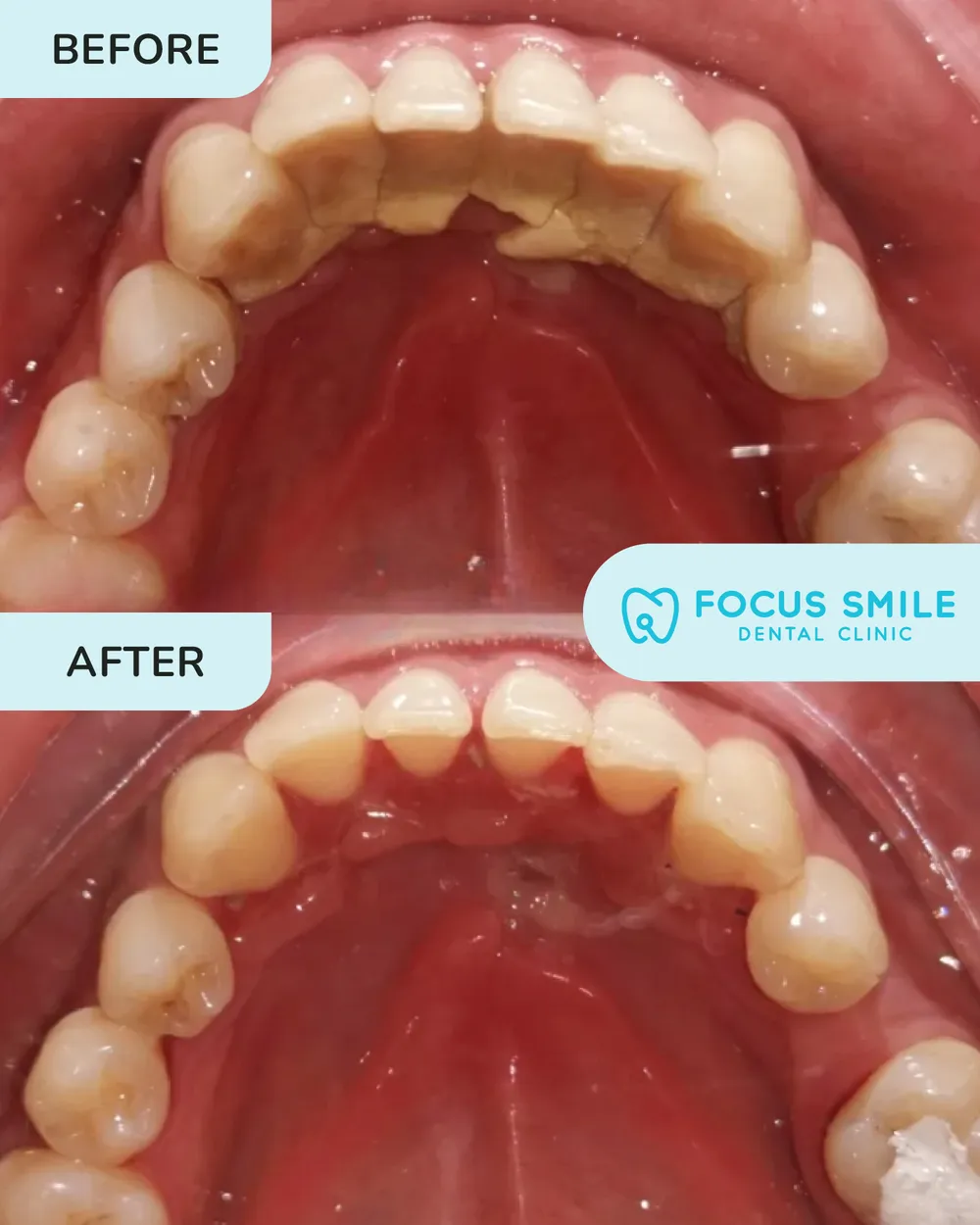 Scaling and polishing before and after, case 1, at Focus Smile Dental