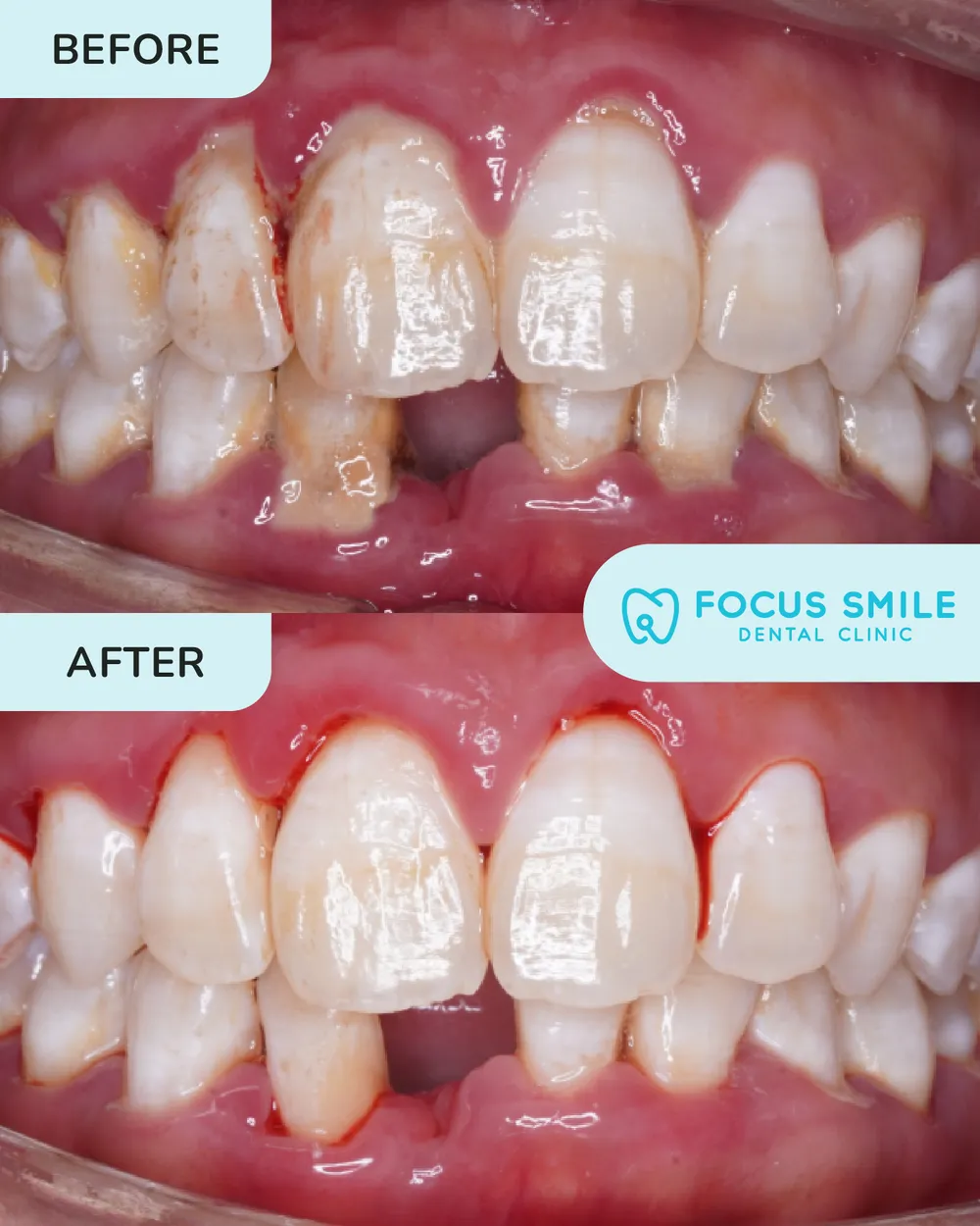 Skeling & Penggilapan before and after result at Focus Smile Dental
