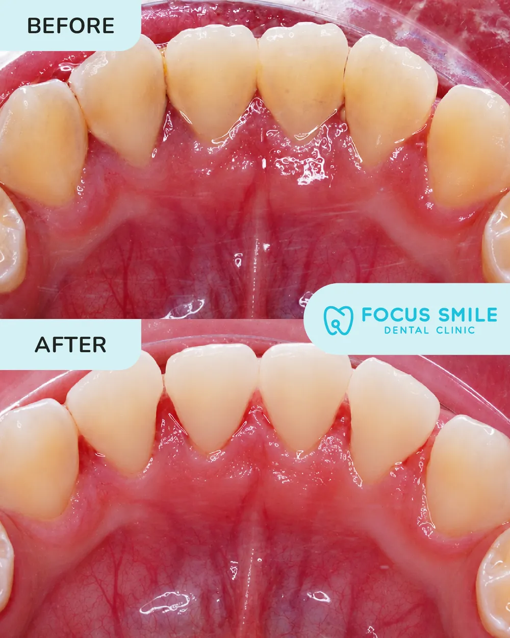Skeling & Penggilapan before and after result at Focus Smile Dental