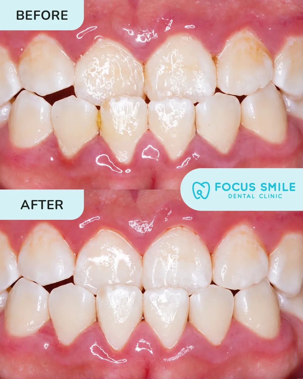 Scaling and polishing before and after, case 5, at Focus Smile Dental