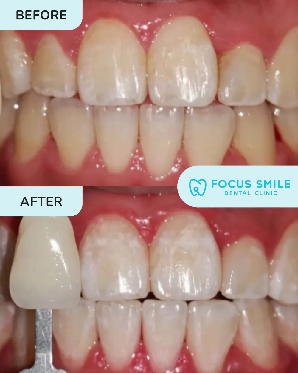 Pemutihan Gigi before and after result at Focus Smile Dental