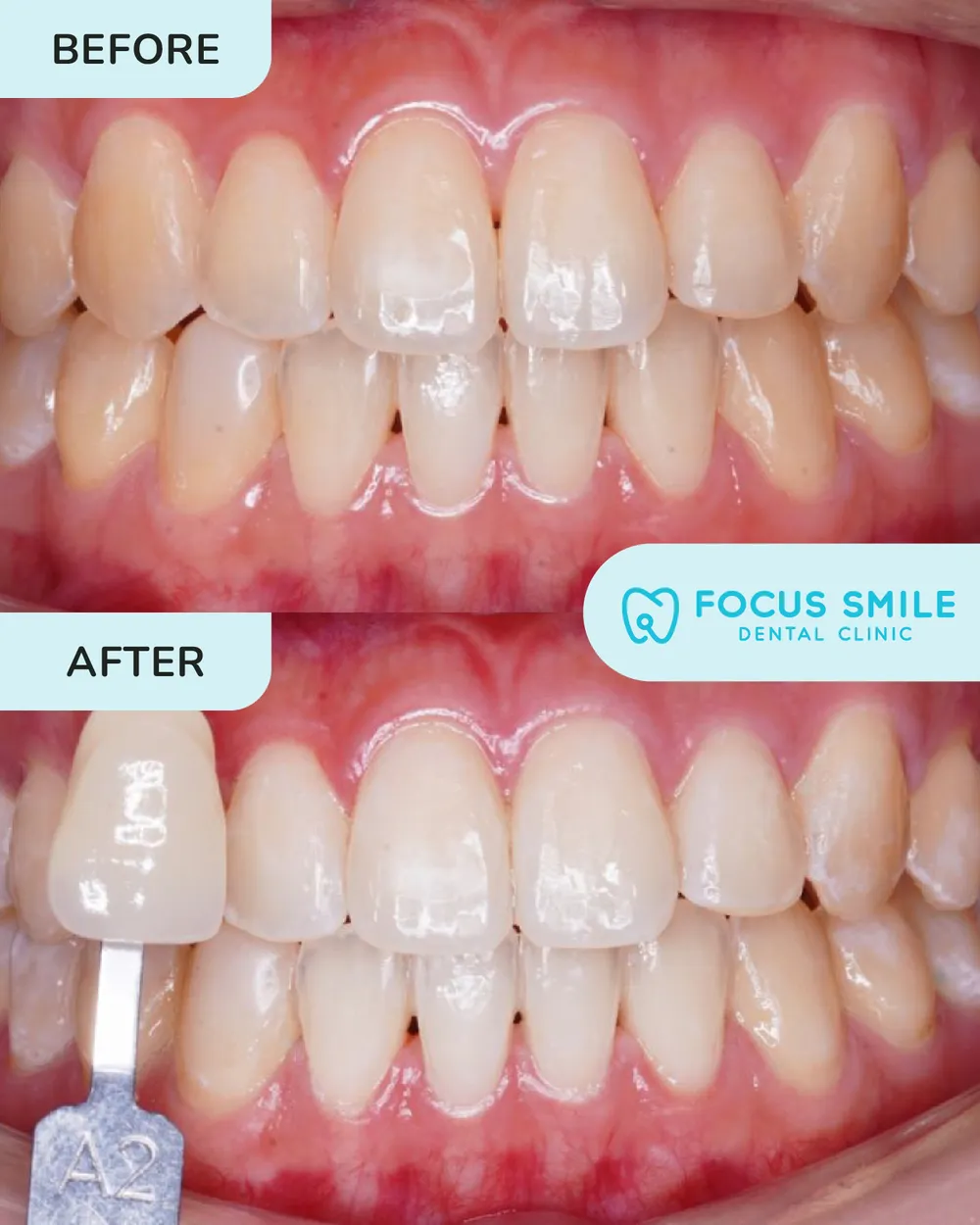 Focus Smile Dental 牙齿美白前后对比，病例 2