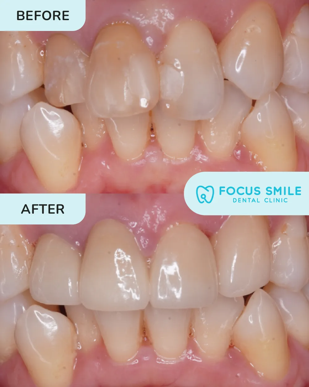Venir before and after result at Focus Smile Dental