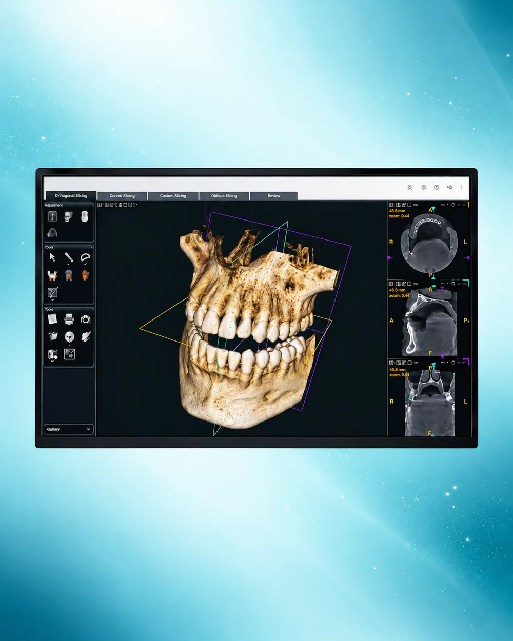 Imbasan digital 3D gigi dan rahang dipaparkan pada skrin